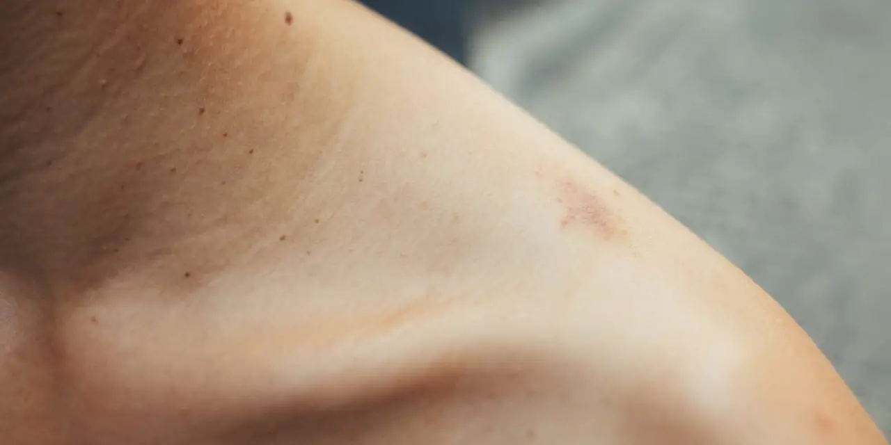 How To Cover Up a Hickey Without Concealer (2 Easy Ways)